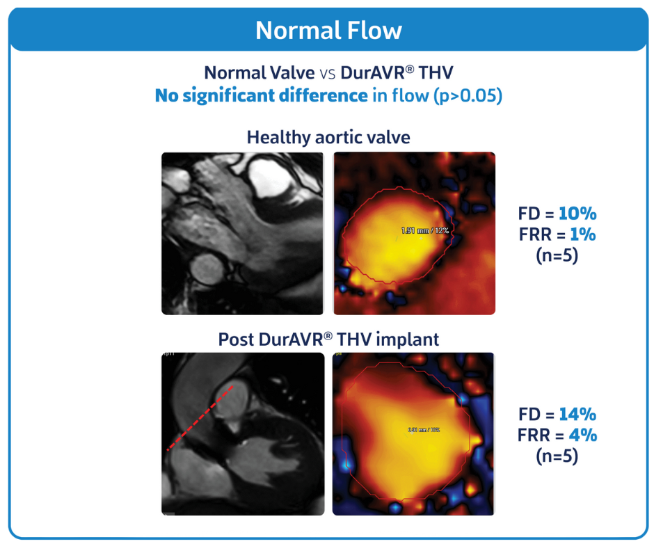 Normal Valve Flow vs DurAVR Flow
